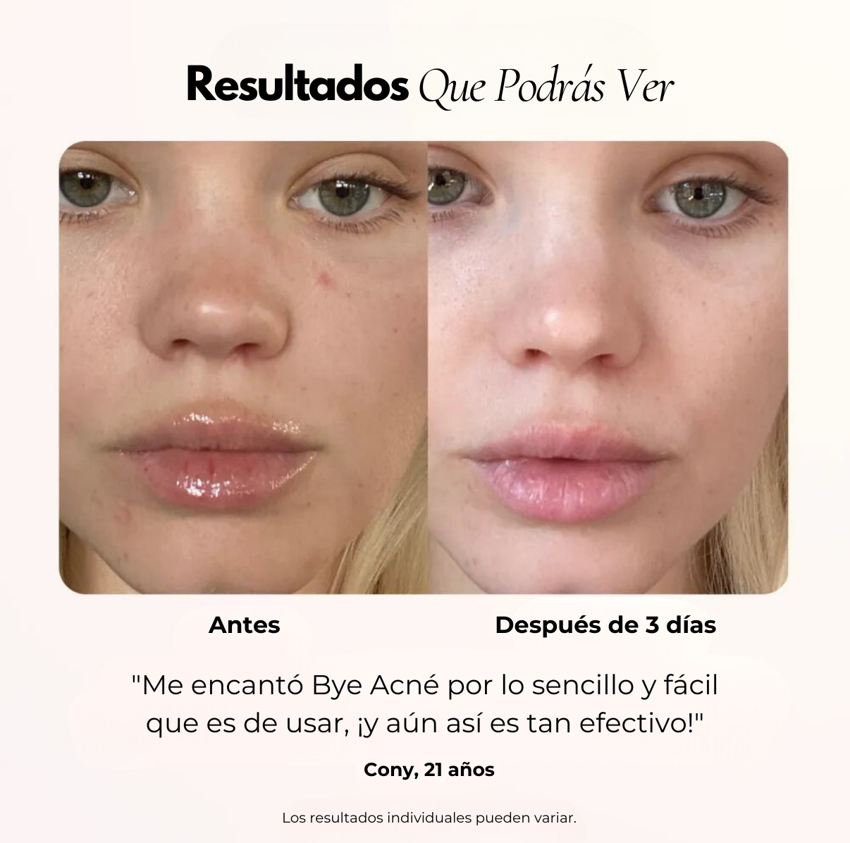 Bye Acné™ Tratamiento para las espinillas en 3 minutos